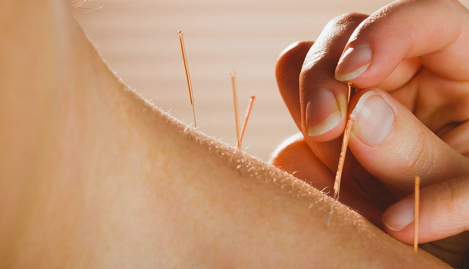 acupuntura en Lugo